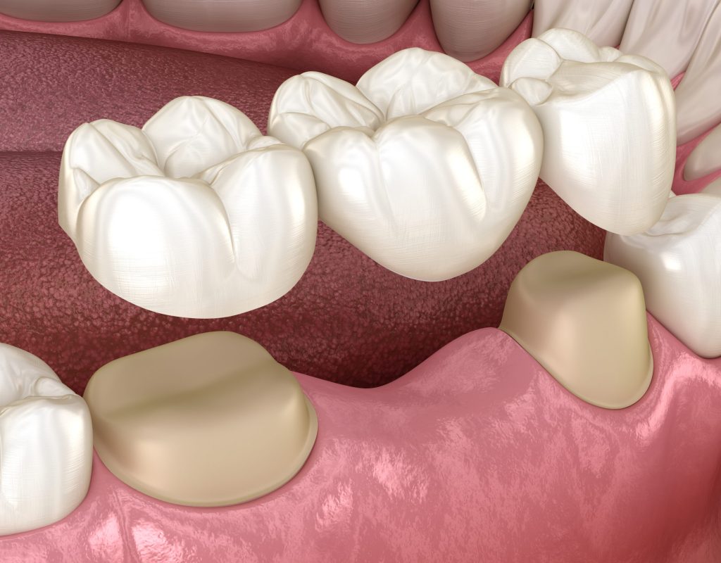 Dental,Bridge,Of,3,Teeth,Over,Molar,And,Premolar.,Medically Dental,Bridge,Of,3,Teeth,Over,Molar,And,Premolar.,Medically