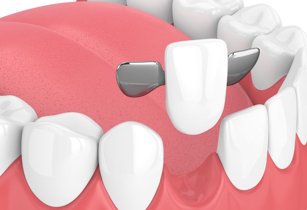 3d,Render,Of,Jaw,With,Teeth,And,Maryland,Bridge,In 3d,Render,Of,Jaw,With,Teeth,And,Maryland,Bridge,In