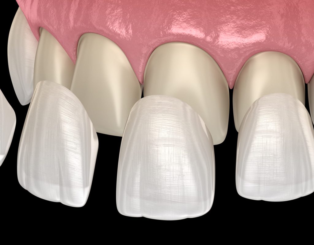 Veneer,Installation,Procedure,Over,Central,Incisor,And,Lateral,Incisor.,Medically Veneer,Installation,Procedure,Over,Central,Incisor,And,Lateral,Incisor.,Medically